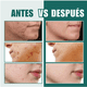 thumbnail image 2 of 112 Star-parches Invisibles UNIVERSOENLINEA.COM Eliminar Acne Estrella Granos, 2 of 9
